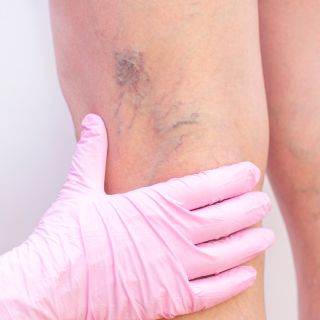 Diminuează vizibilitatea venelor